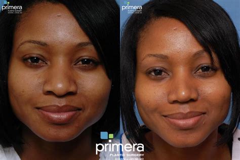 plastic surgeons that specialize in african american rhinoplasty