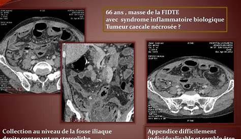 (PDF) Plastron appendiculaire intervention en urgence ou