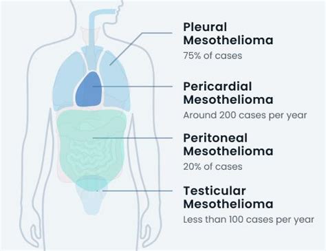 pleural vs peritoneal mesothelioma