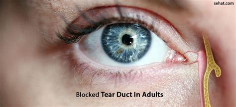 Understanding and Treating a Plugged Tear Duct Effectively Today