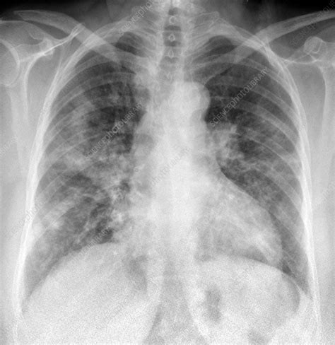 Decoding Pneumonia X-Rays: Key Detection Insights