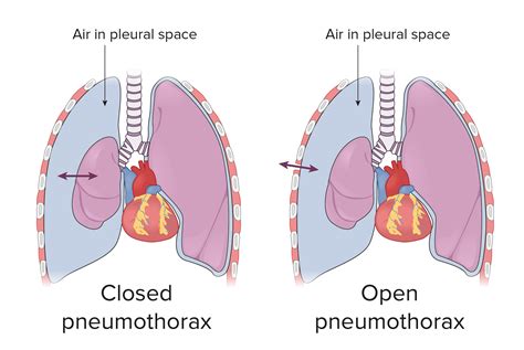 Pneumothorax oorzaken, symptomen, behandeling