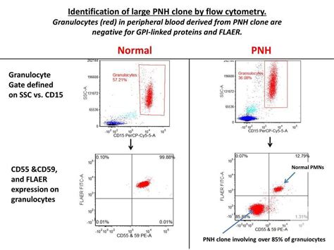 pnh testing by flow cytometry