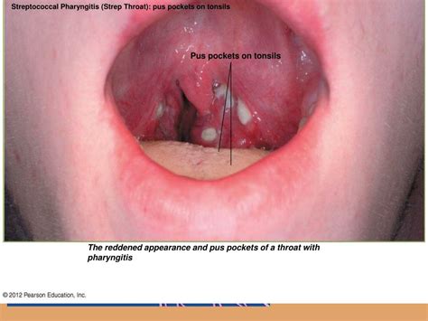 Pockets In Tonsils