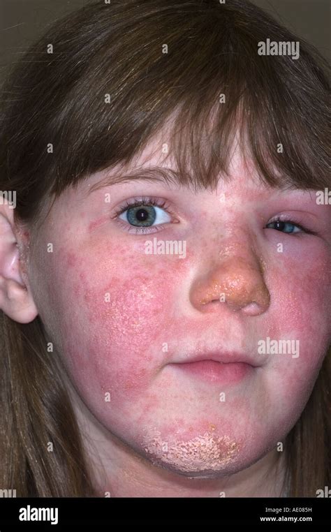 Poison Sumac On Face