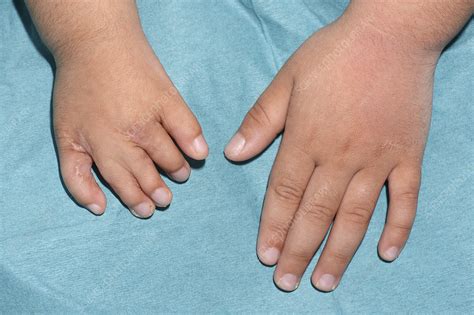 poland syndrome hand deformity