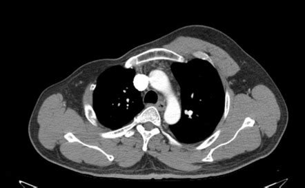 poland syndrome radiopaedia