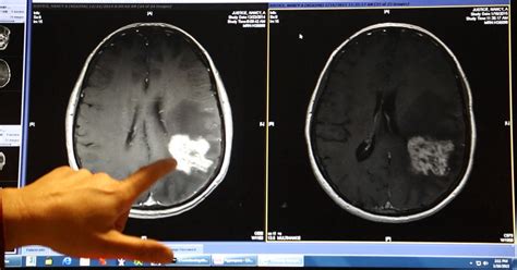 polio brain tumor treatment