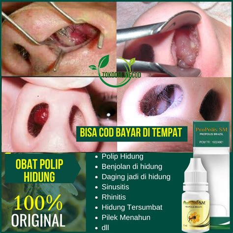 Obat Polip Hidung Sembuh Tanpa Operasi obat herbal