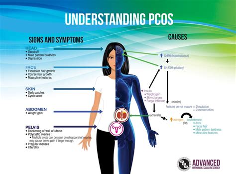 polycystic ovary syndrome symptoms nhs