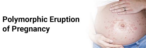 Understanding Polymorphic Eruption of Pregnancy: Causes, Symptoms, and Treatment Options