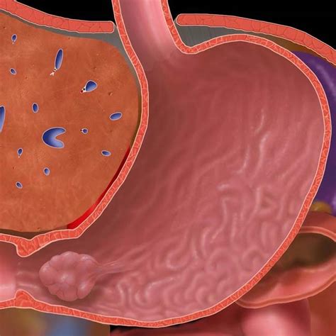 Understanding the Polyp of the Stomach: Causes, Symptoms, and Treatment Options