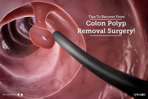 polyp removal surgery recovery time