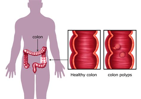 Polyps In Colon Causes