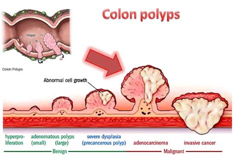 Polyps In Colon In Spanish