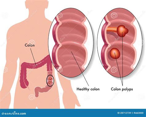 Polyps In Colon Side Effects