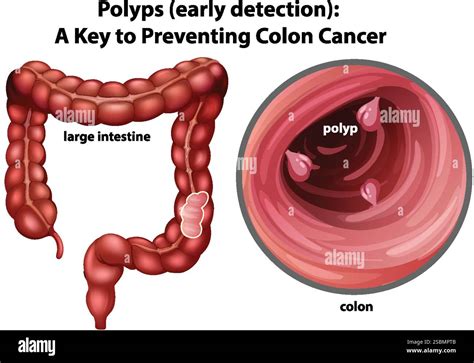 Polyps In Colon Wiki