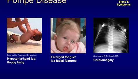 Pompe Disease Child Guide To Infantile