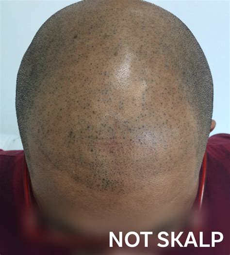 Poor research with scalp micropigmentation