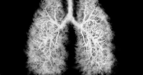 Popcorn Lung Mortality