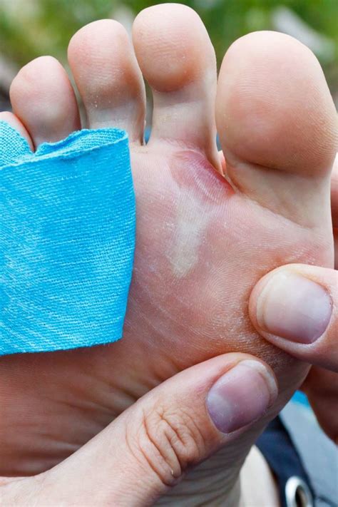 What Happens When You Popped a Blister: Risks, Remedies, and Prevention Tips