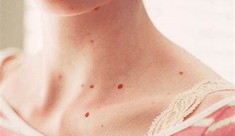 ¿Qué significan los puntos rojos que salen en la piel? | Puntos rojos