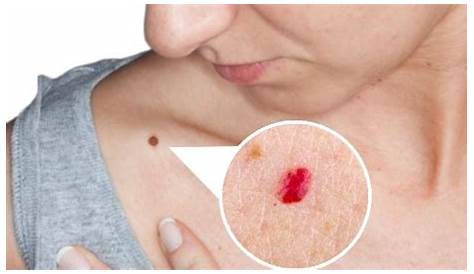 Lunares rojos, angiomas o puntos rojos en la piel - ¿Cómo eliminarlos?