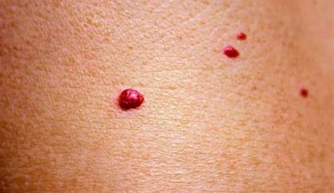 ¿Qué significan los puntos rojos que salen en la piel? | Bioguia