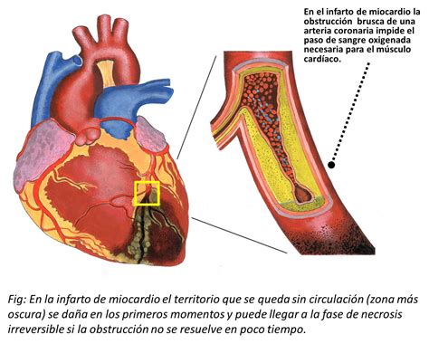 porque se da un infarto agudo al miocardio