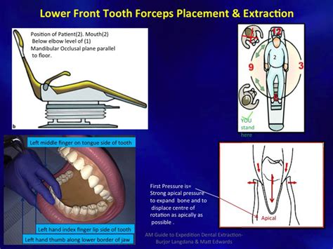 position for dental extraction