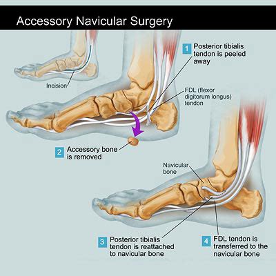 Post Accessory Navicular Surgery
