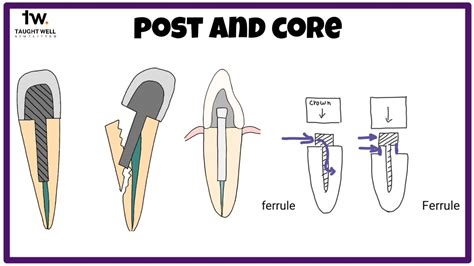 Post And Core In Endodontics
