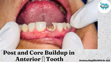 Post Build Up Dental Code