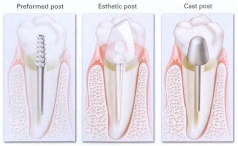 Post Dentistry Meaning