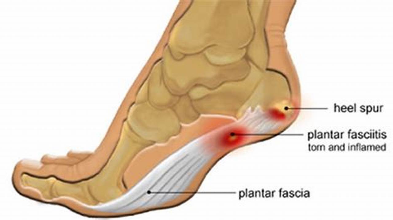 Posterior Tibial Tendonitis vs Plantar Fasciitis