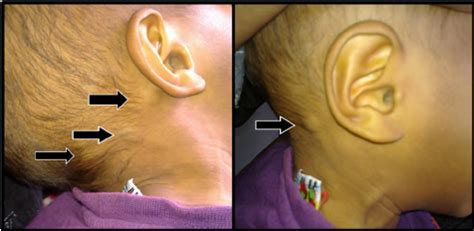 posterior auricular lymph node swollen one side