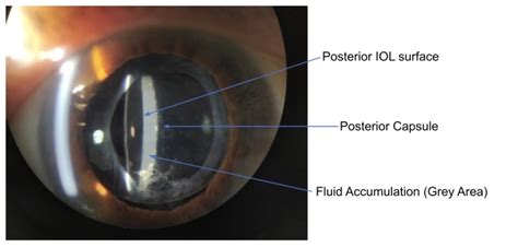 Posterior Capsular Opacification Development