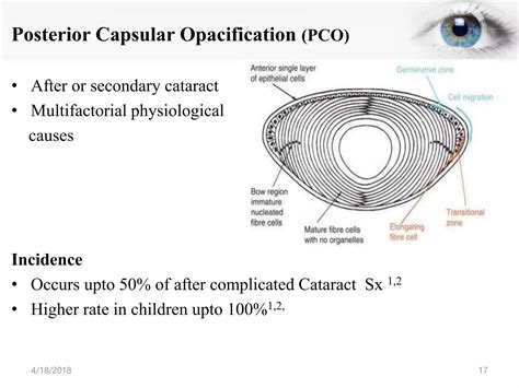 Posterior Capsular Opacification Frequency