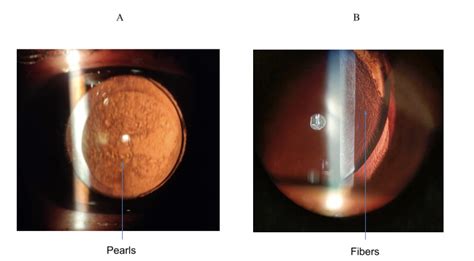 Posterior Capsule Opacification Fundoscopy