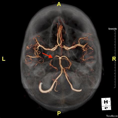 posterior cerebral artery stenosis