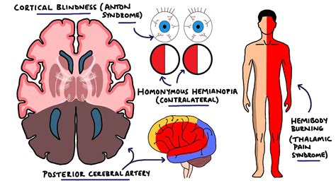 posterior cerebral artery syndrome