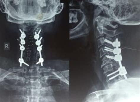 posterior cervical spinal fusion