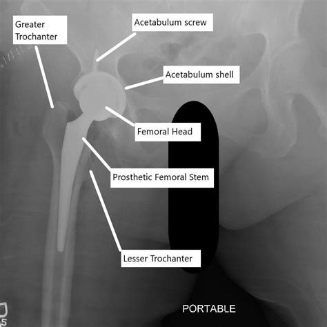 posterior hip replacement