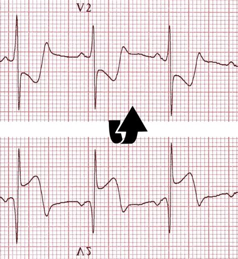 posterior mi ecg trick