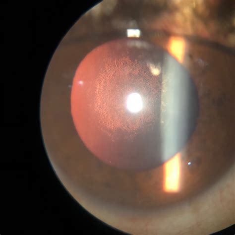 posterior subcapsular cataract