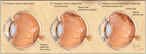 posterior vitreous degeneration eye