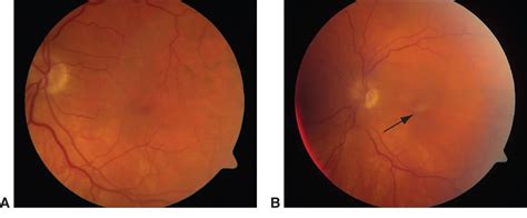 posterior vitreous detachment icd 10 criteria