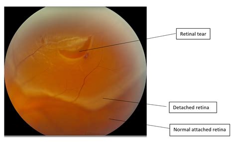 posterior vitreous detachment vs retinal tear