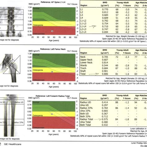 Postmenopausal Icd-10 For Bone Density