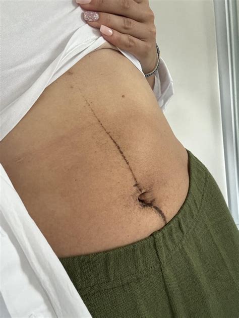 Postpartum Hernia Reddit